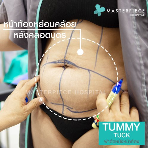 ผ่าตัด ตัดหนังหน้าท้อง tummy ผ่าตัด ตัดหนังหน้าท้อง tummy