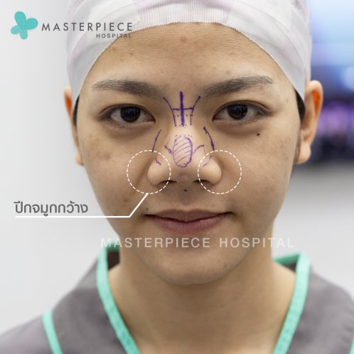 ตัดปีกจมูกอย่างเดียวไม่ต้องเสริมก็สวยได้? ตัดปีกจมูกอย่างเดียวไม่ต้องเสริมก็สวยได้?