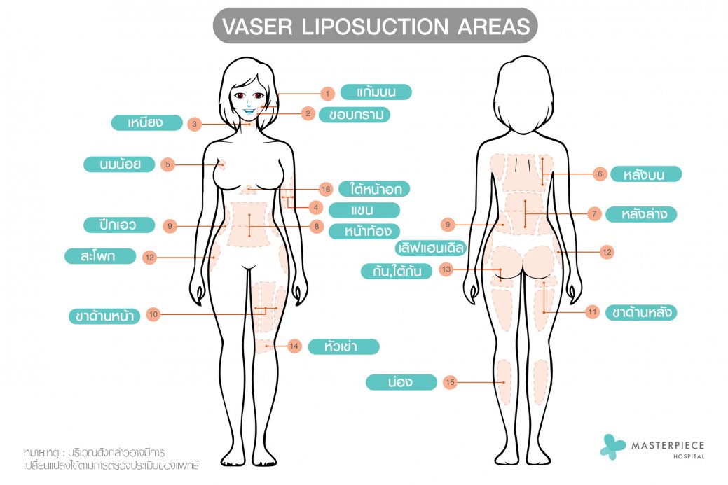 ดูดไขมัน vaser มาสเตอร์พีซ ดูดไขมัน vaser