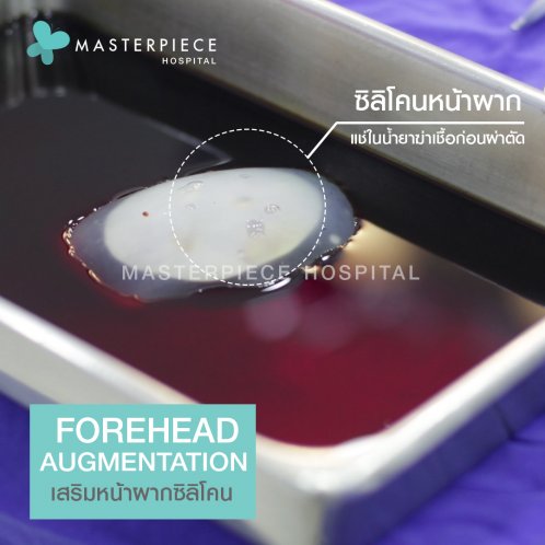 ซิลิโคนหน้าผาก ซิลิโคนหน้าผาก