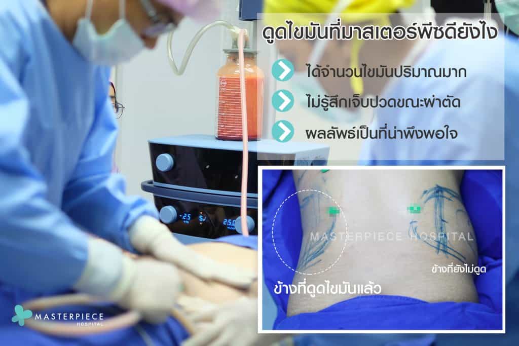 ดูดไขมัน ดียังไง