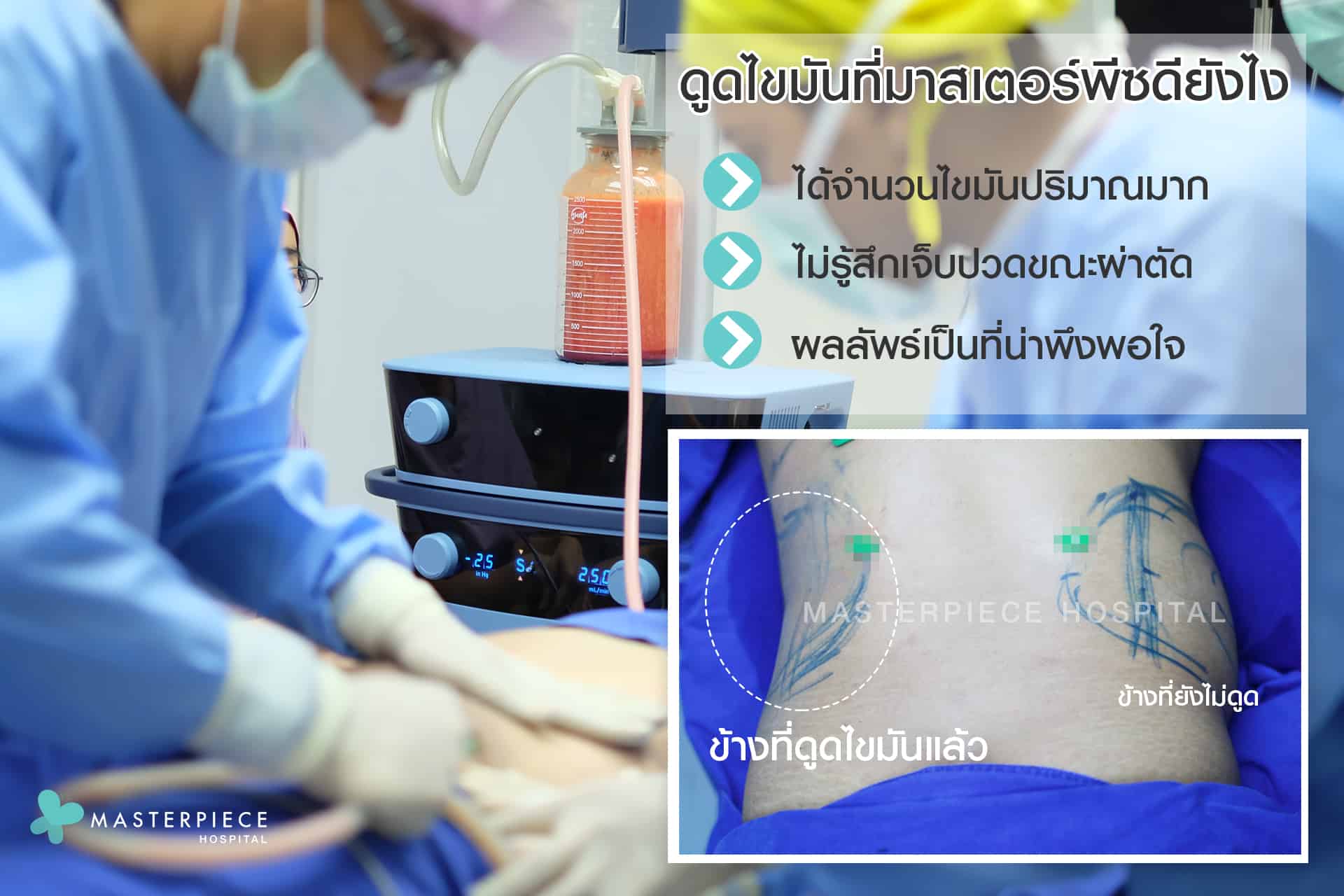 ดูดไขมัน ดียังไง