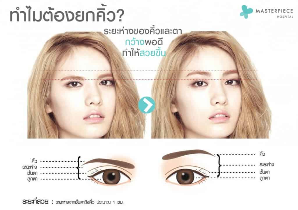 การยกคิ้วแบบดั้งเดิม เทคนิค DIRECT BROW LIFT