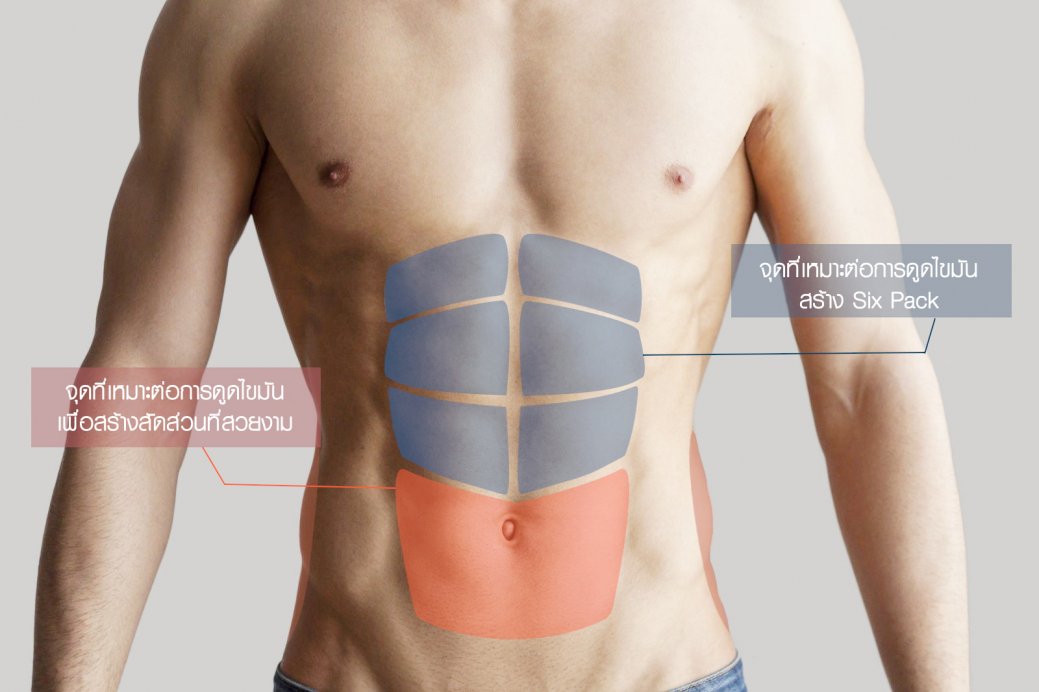 บริเวณ ดูดไขมัน ซิกแพค (SIX PACK LIPOSUCTION) บริเวณ ดูดไขมัน ซิกแพค (SIX PACK LIPOSUCTION)