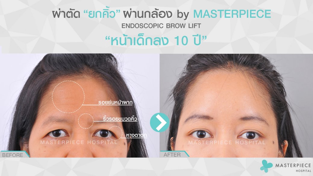 ผ่านตัดยกคิ้วผ่้านกล้อง ผ่านตัดยกคิ้วผ่้านกล้อง