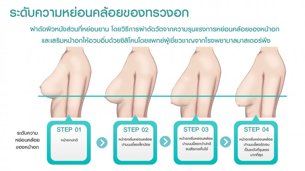 ยกกระชับทรวงอก ระดับความหย่อน ยกกระชับทรวงอก ระดับความหย่อน