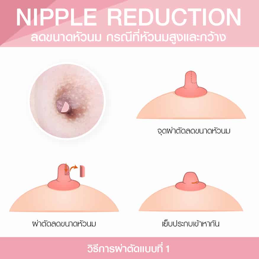 ลดขนาดหัวนม กรณีหัสนมสูงและกว้าง