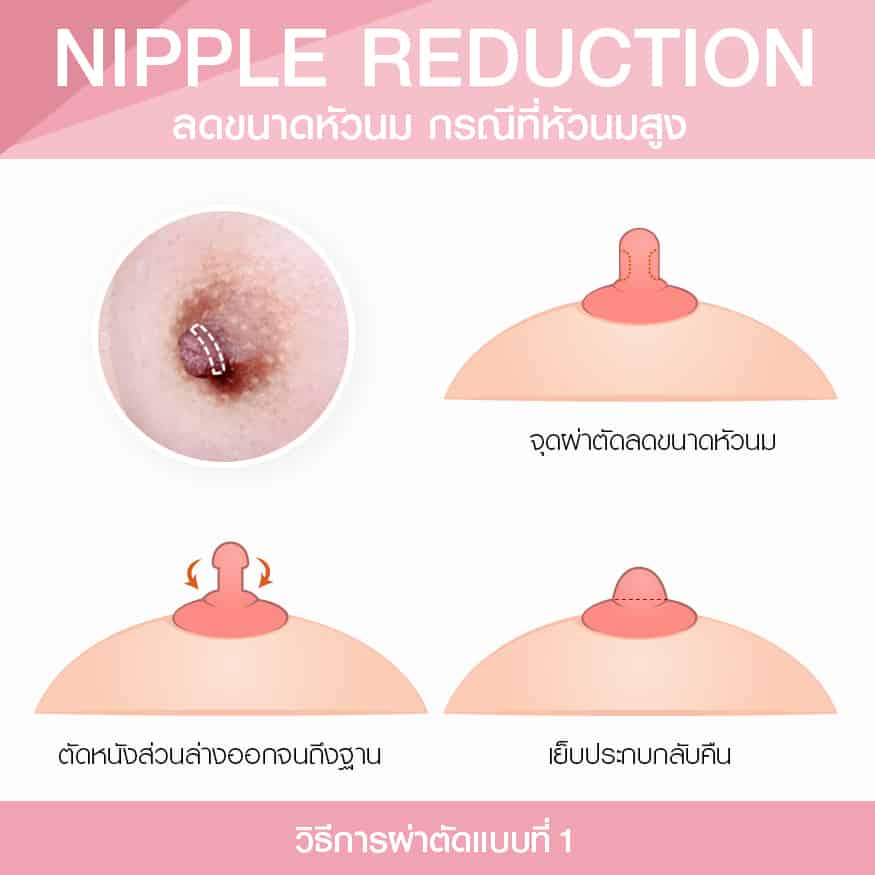 ลดขนาดหัวนม กรณีหัวนมสูง