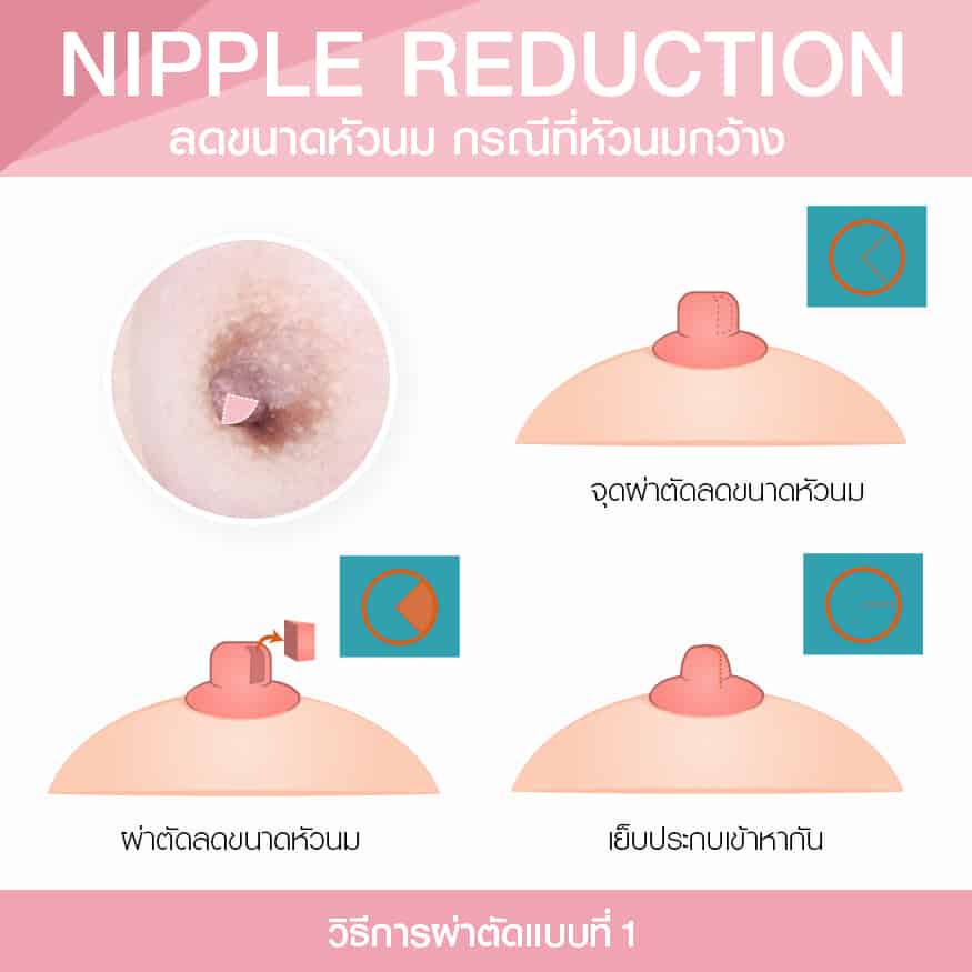 ลดขนาดหัวนม กรณีหัวนมกว้าง