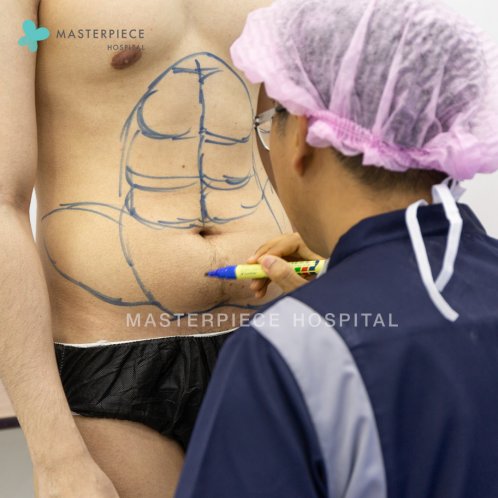 ดูดไขมัน ซิกแพค (SIX PACK LIPOSUCTION) ดูดไขมัน ซิกแพค (SIX PACK LIPOSUCTION)