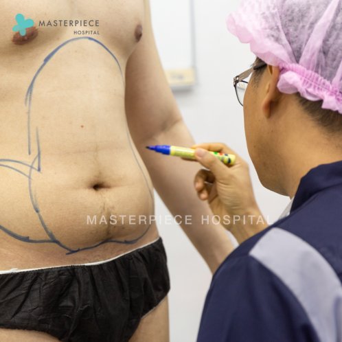 ดูดไขมัน ซิกแพค (SIX PACK LIPOSUCTION) ดูดไขมัน ซิกแพค (SIX PACK LIPOSUCTION)