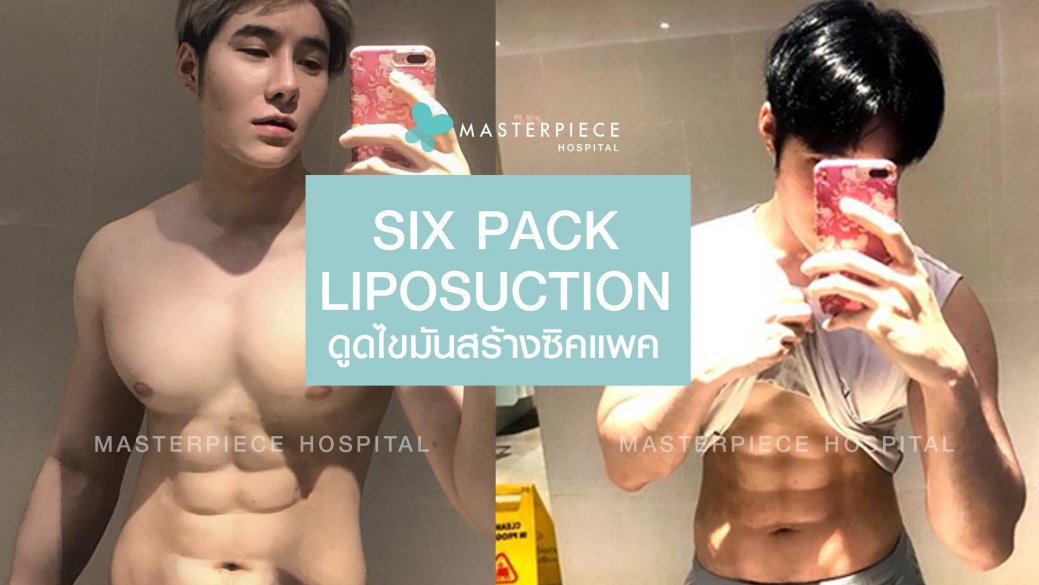 ดูดไขมัน ซิกแพค (SIX PACK LIPOSUCTION) ดูดไขมัน ซิกแพค (SIX PACK LIPOSUCTION)