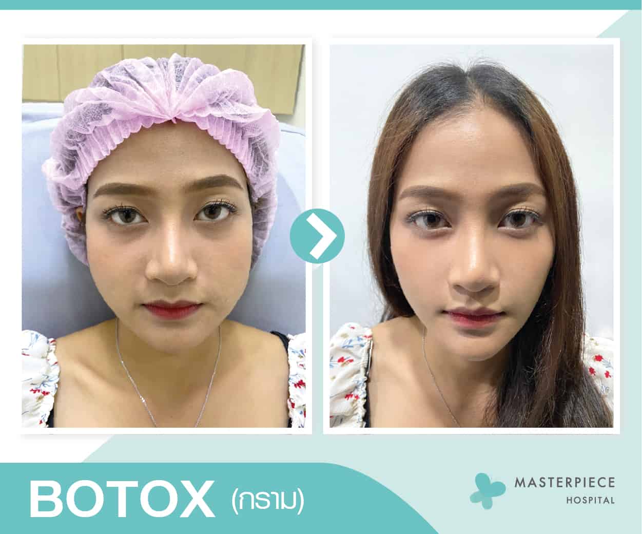 Botox โบท็อกซ์กราม