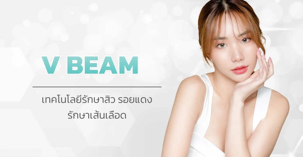 V Beam