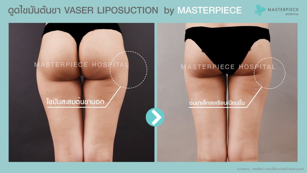 ดูดไขมันต้นขา VASER LIPOSUCTION MASTERPIECE HOSPITAL