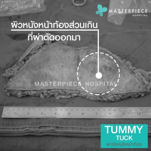 ผ่าตัด ตัดหนังหน้าท้อง tummy ผ่าตัด ตัดหนังหน้าท้อง tummy
