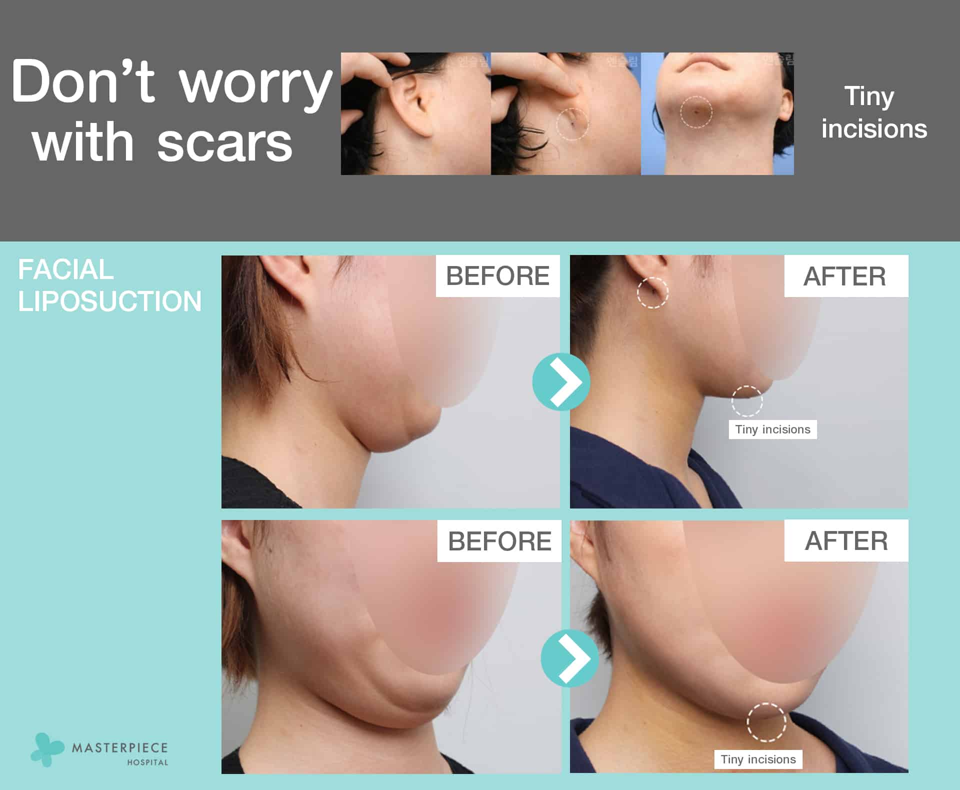 Facial Liposuction by Masterpiece Don’t worry with scars
