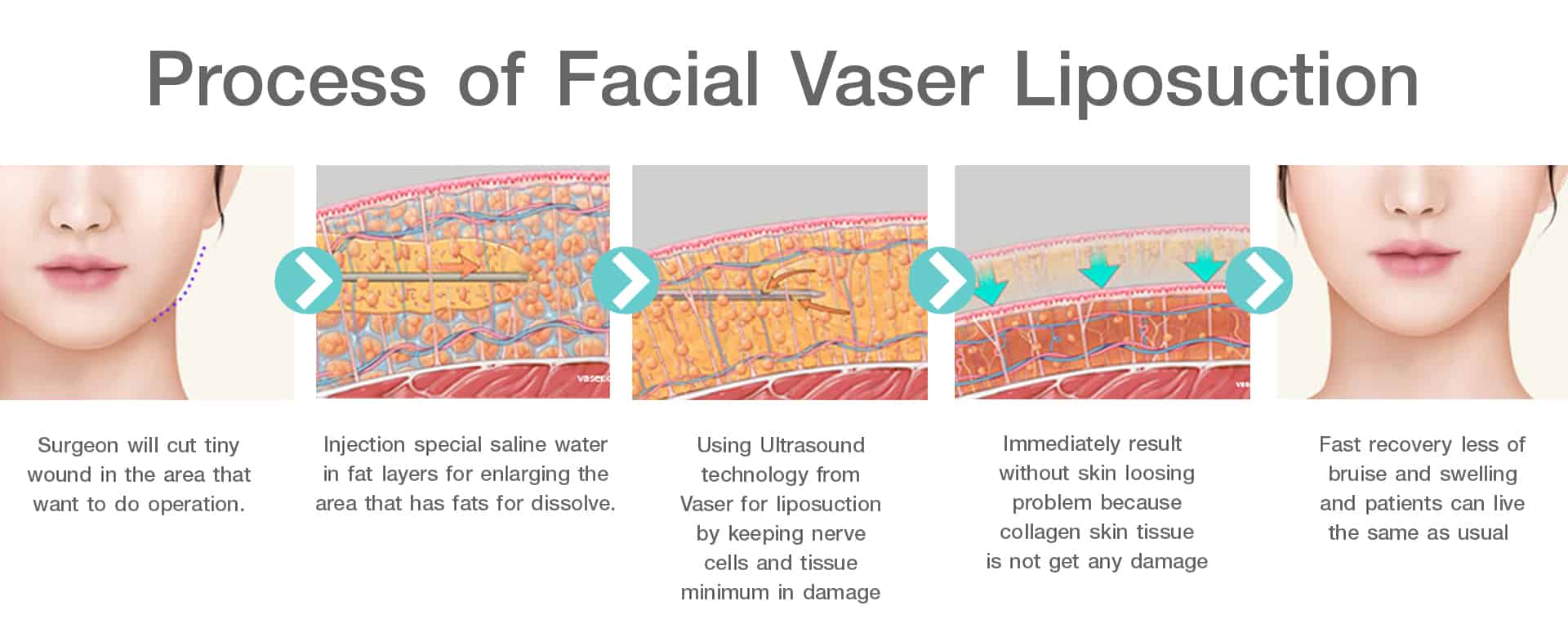 Process of Facial Vaser Liposuction