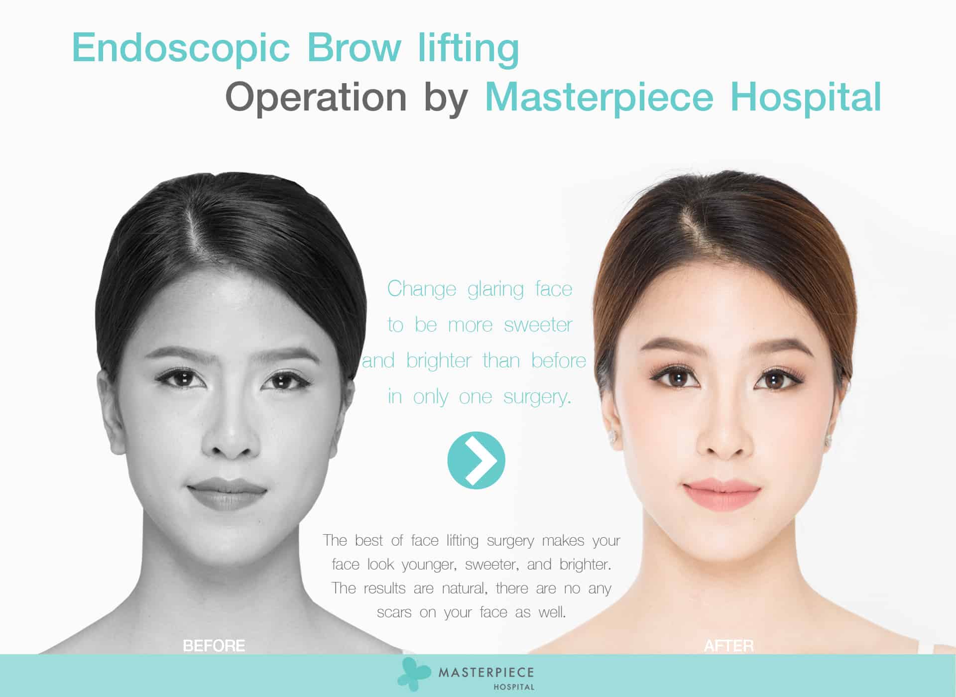 Ad Endoscopic Brow lifting