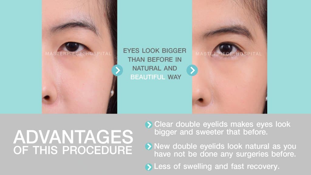 Advantages of this procedure