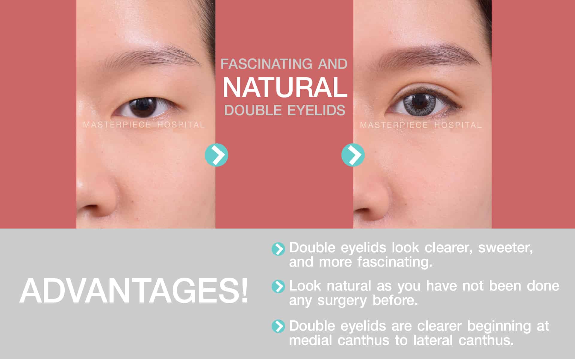 Double Eyelid Surgery Masterpiece Hospital