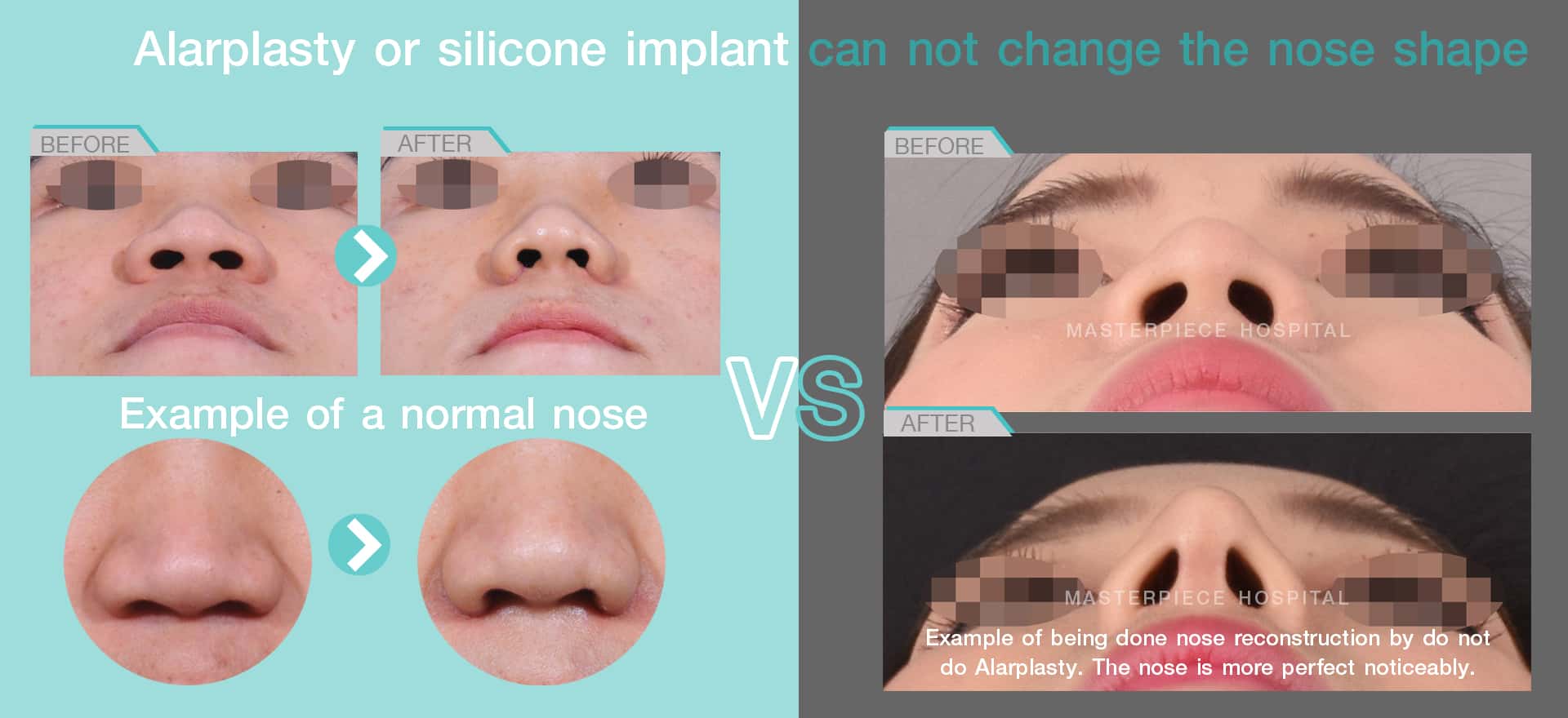 Alarplasty or silicone implant can not change the nose shape
