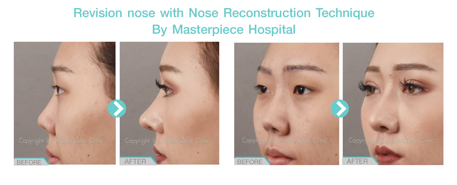 Revision nose with Nose Reconstruction Technique By Masterpiece Hospital