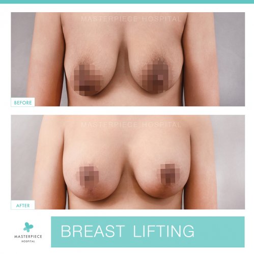 BREAST LIFTING