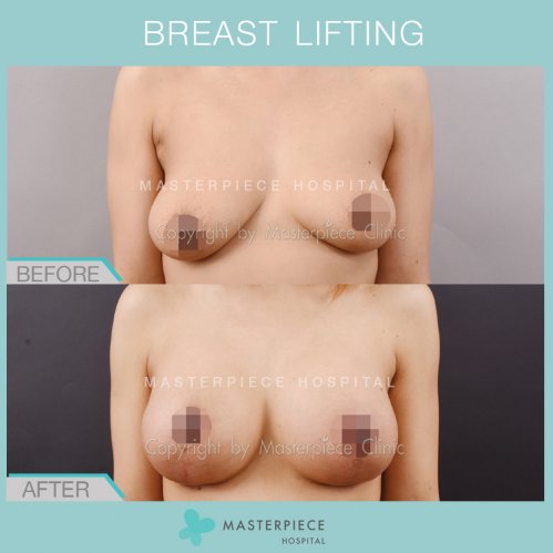 BREAST LIFTING BREAST LIFTING