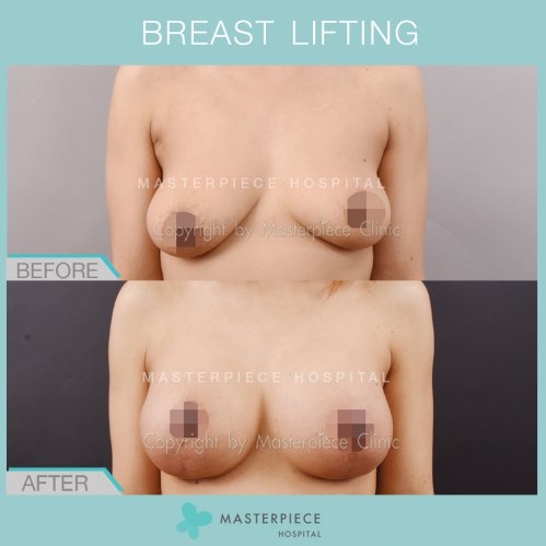 BREAST LIFTING