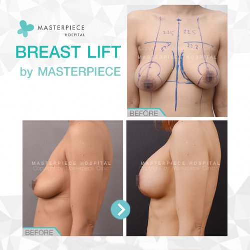 BREAST LIFTING