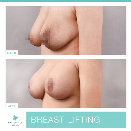 BREAST LIFTING