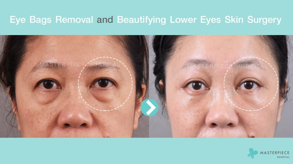 Eye bags removal Masterpiece Hospital