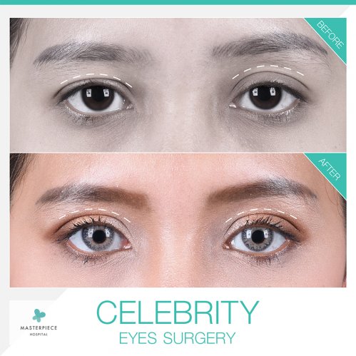 Celebrity Eyes Surgery