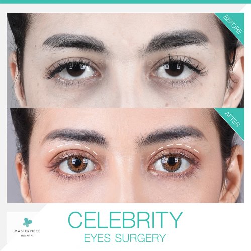 Celebrity Eyes Surgery