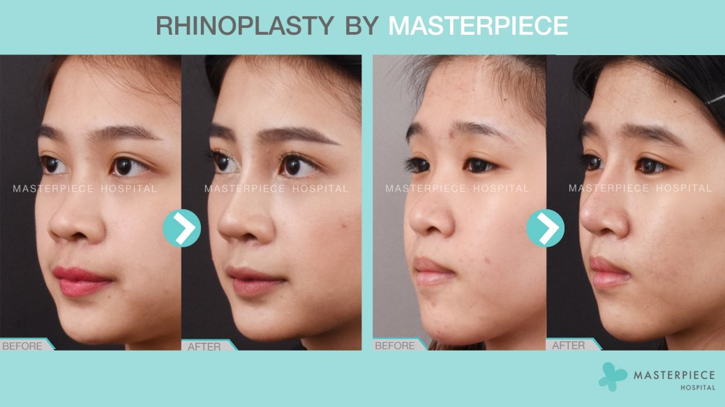 Before After Rhinoplasty