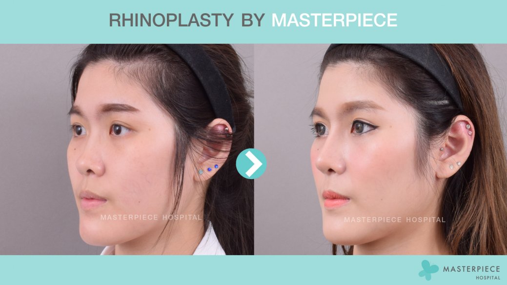 Before After Rhinoplasty