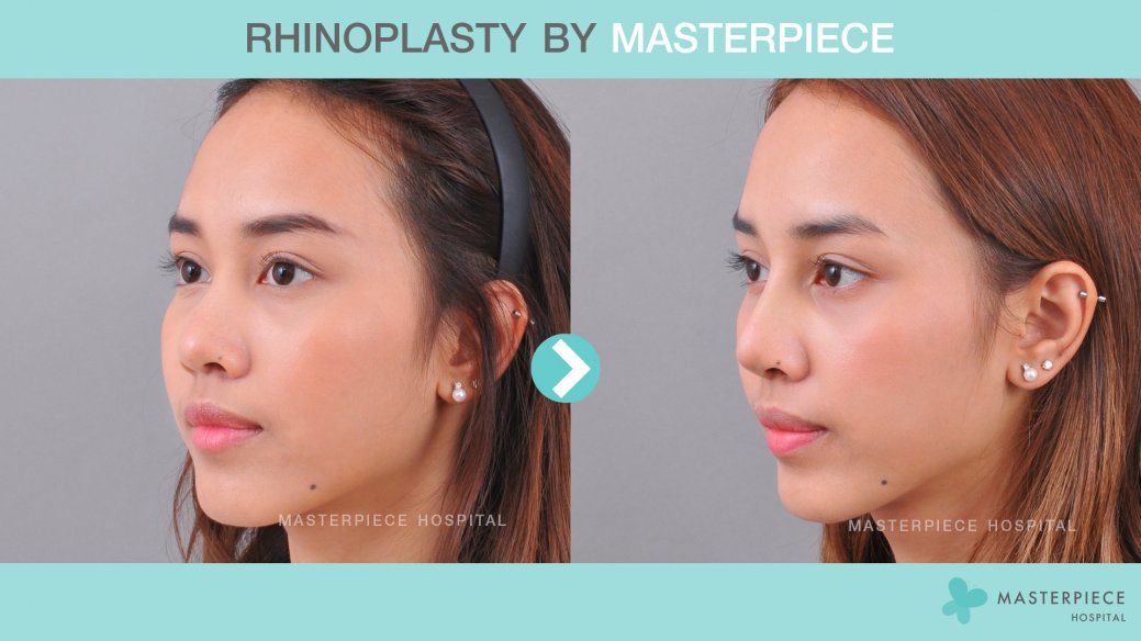 Before After Rhinoplasty