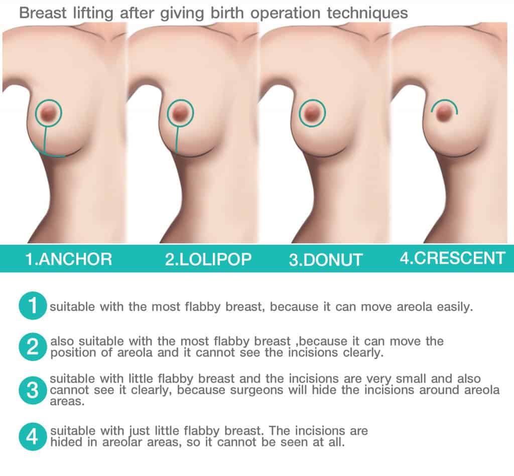 Breast lifting after giving birth operation techniques