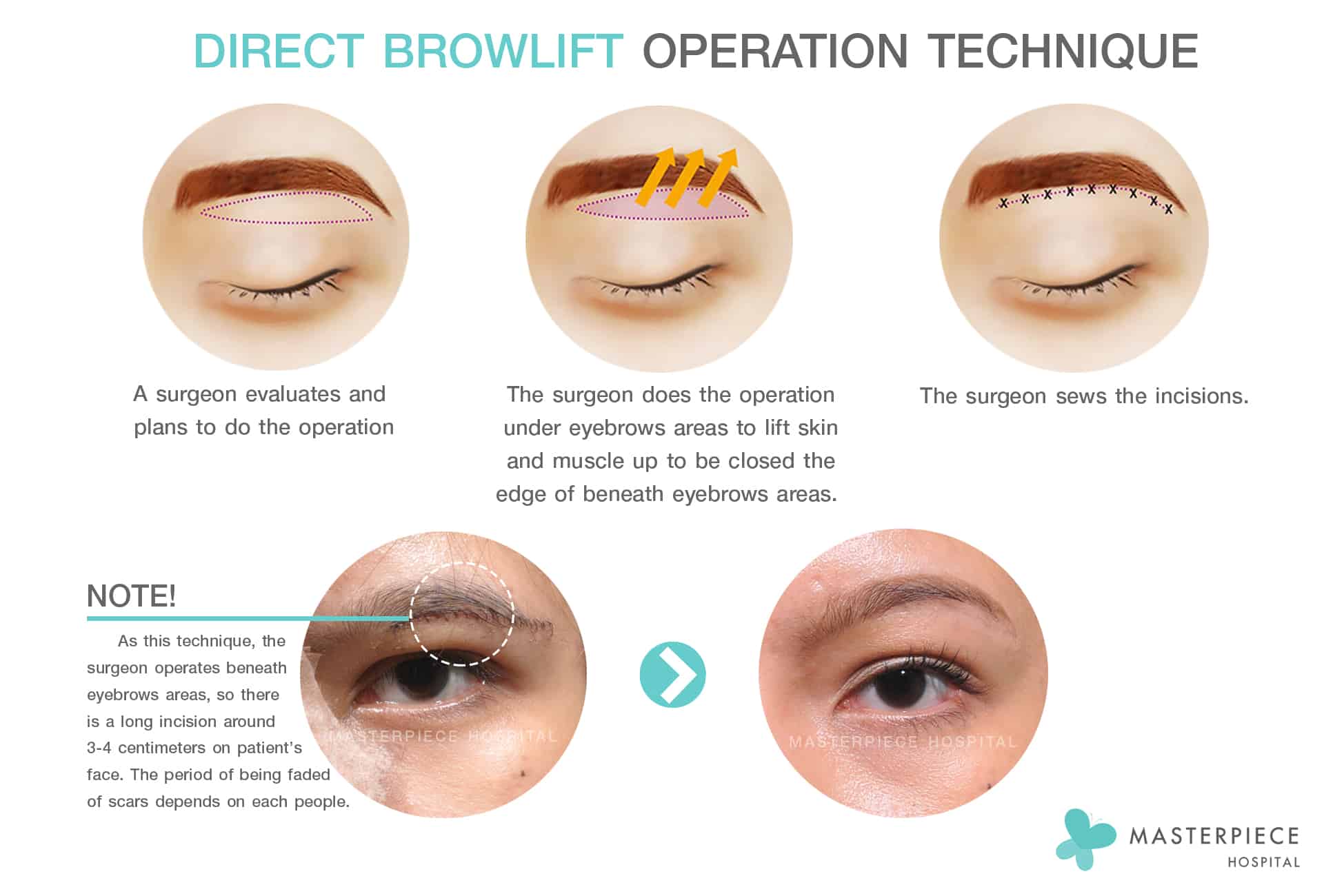 Direct Browlift Operation Technique