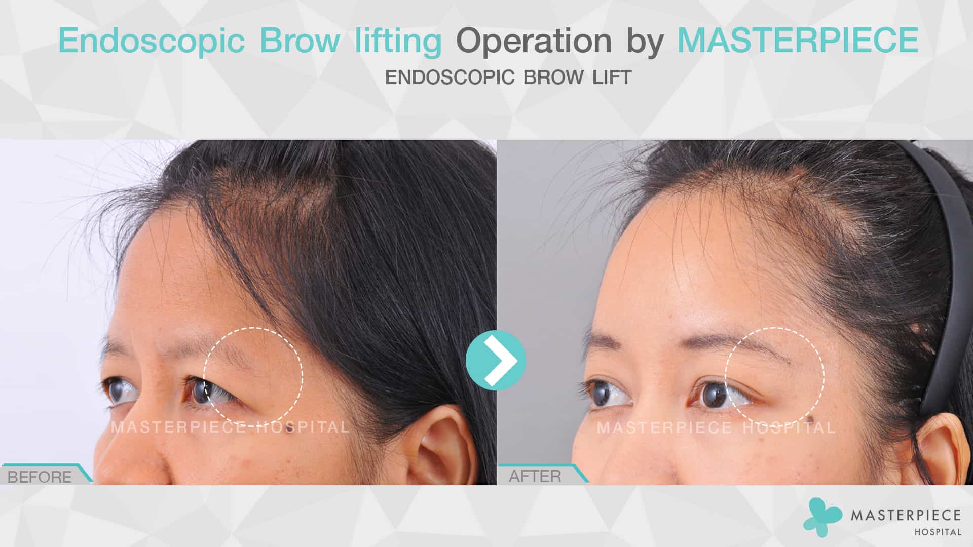 Endoscopic Brow lifting Operation by Masterpiece Hospital 1