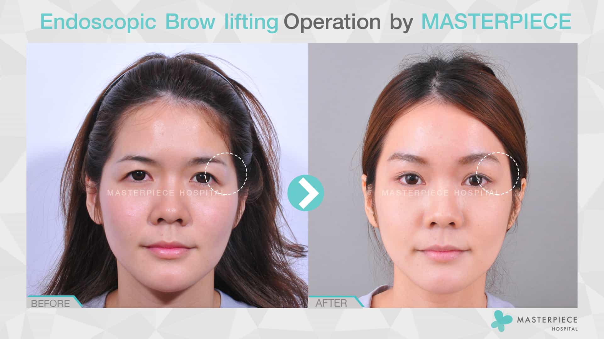 Endoscopic Brow lifting Operation by Masterpiece Hospital