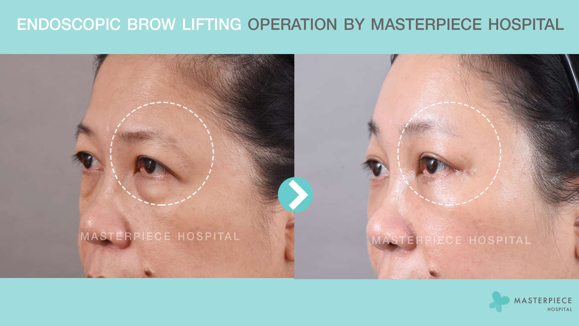 Endoscopic Brow lifting Operation by Masterpiece Hospital