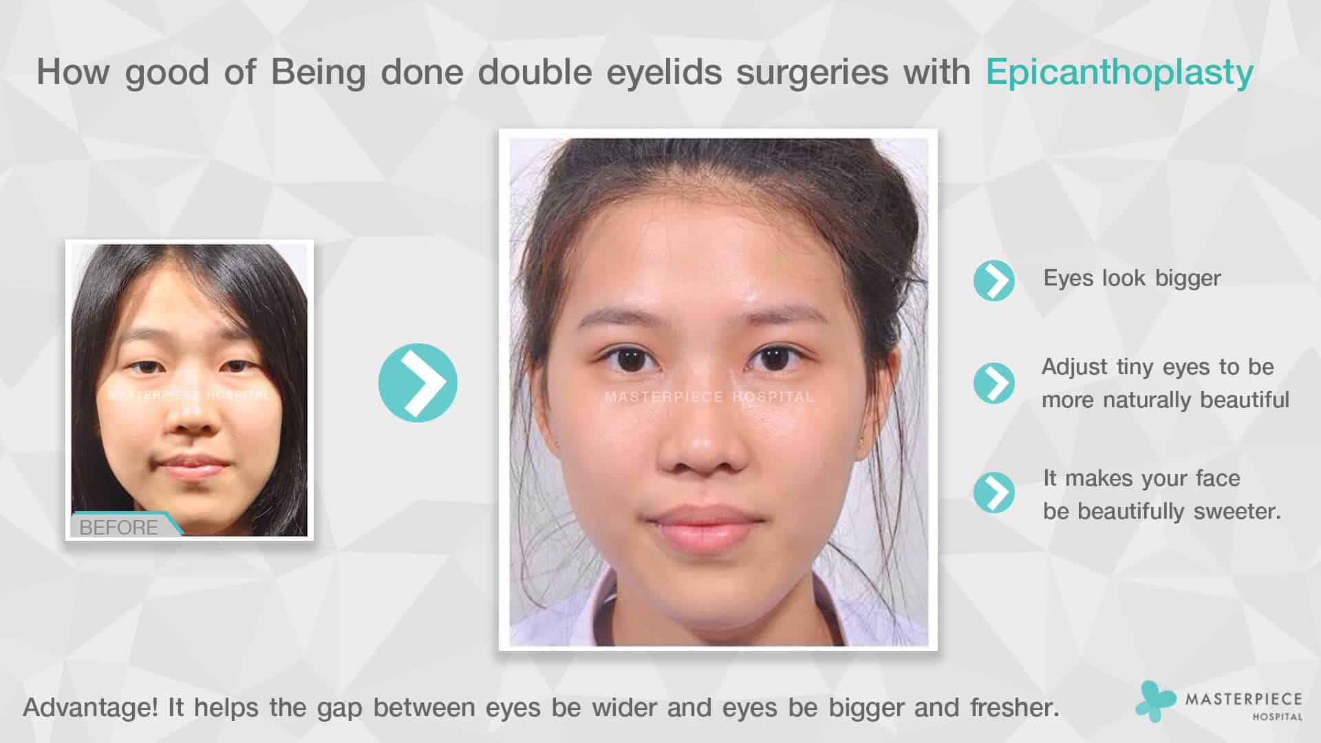 How good of Being done double eyelids surgeries with Epicanthoplasty