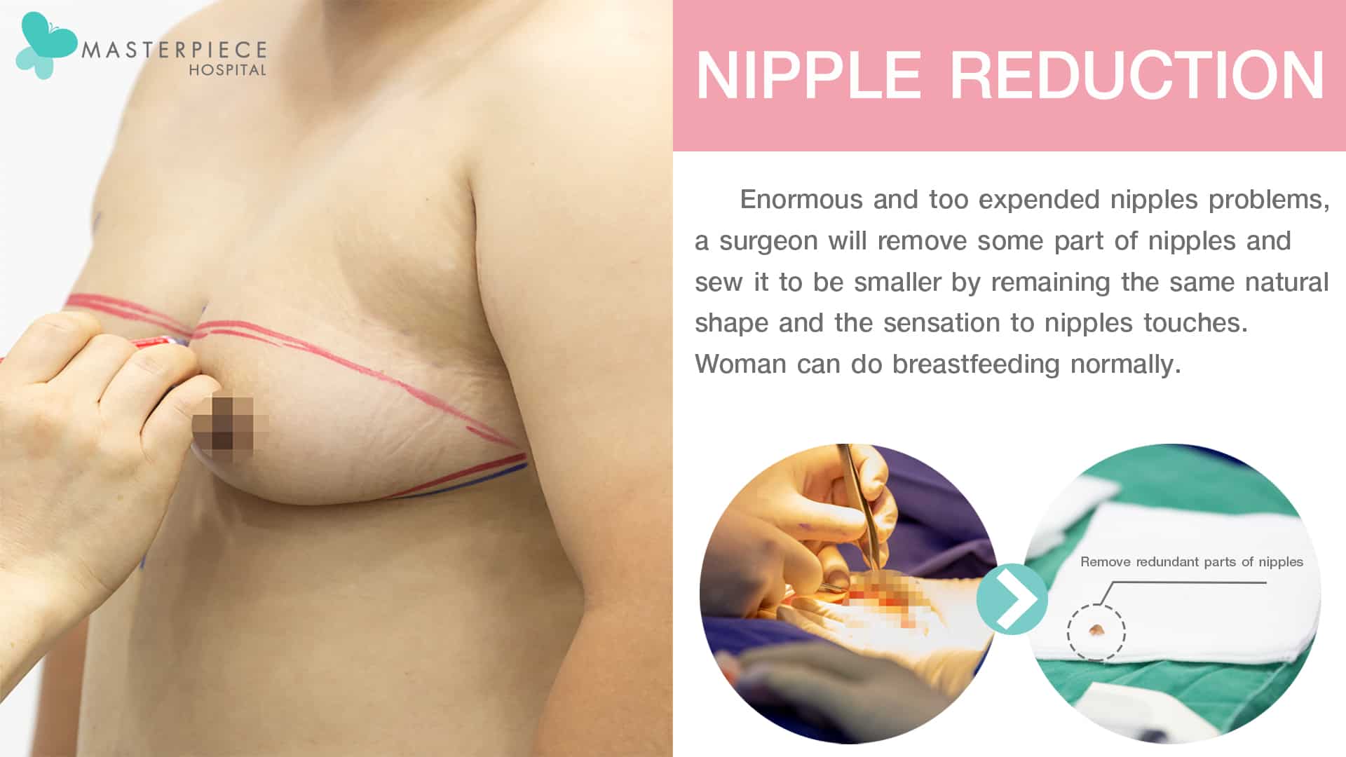 Nipple Reduction