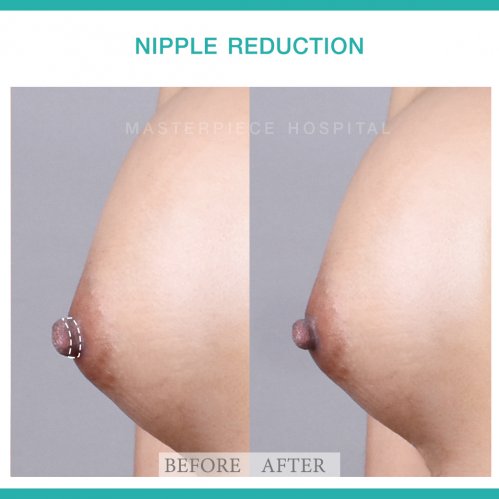 Nipple Reduction Before After