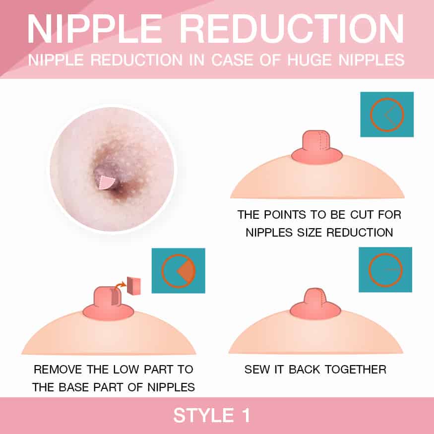 Nipple Reduction In case of huge nipples