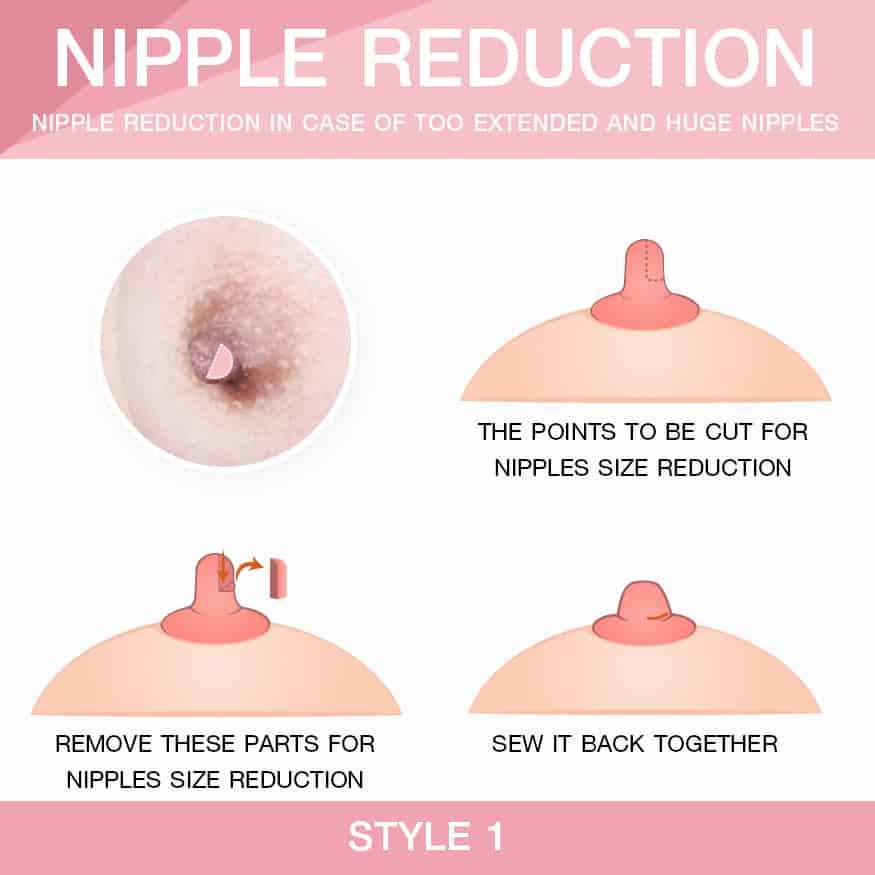 Nipple Reduction In case of too extended and huge nipples