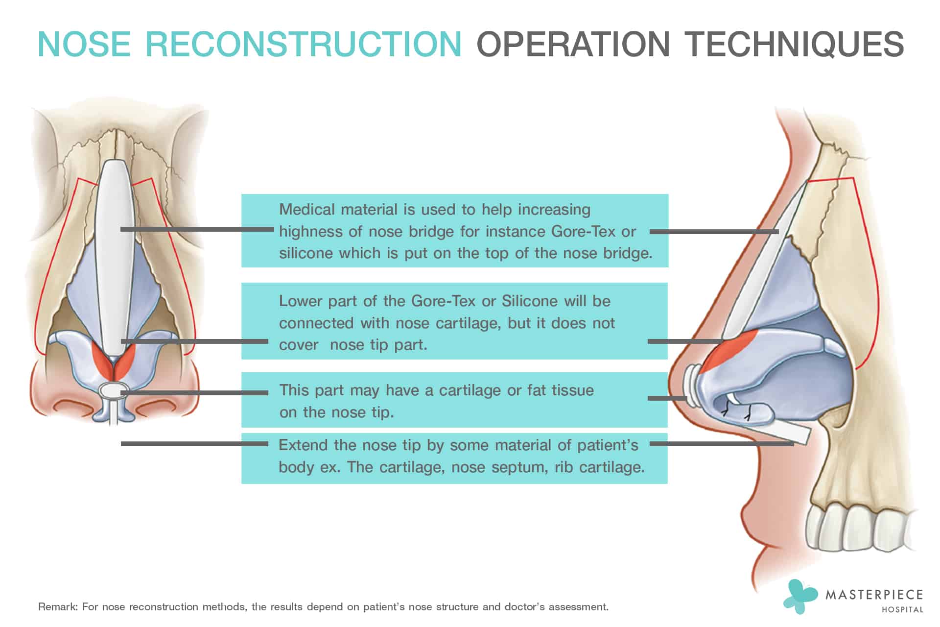 Nose Reconstruction Operation Techniques