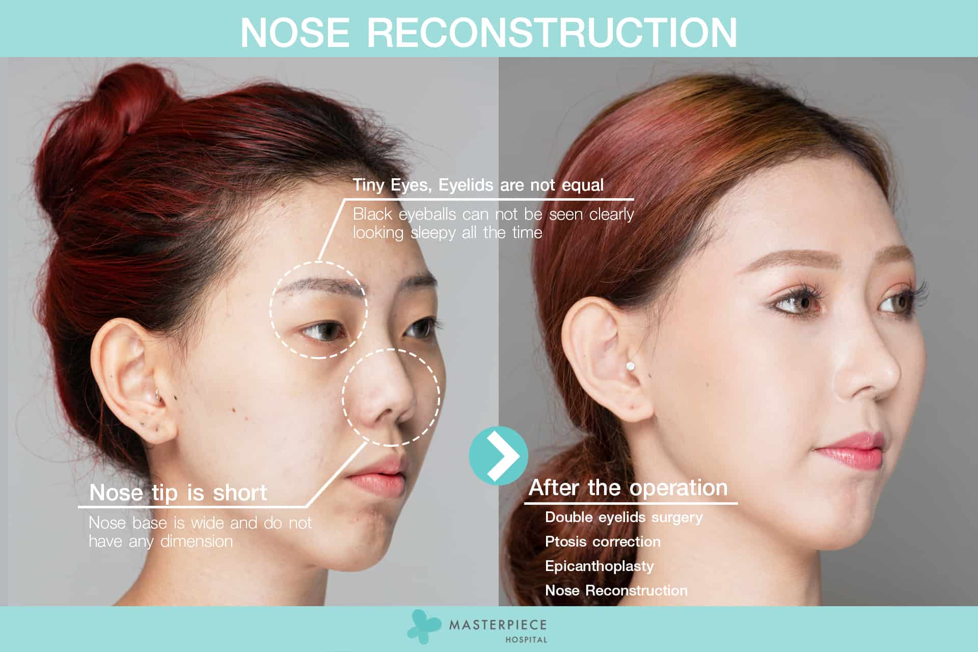 Nose Reconstruction info B&A